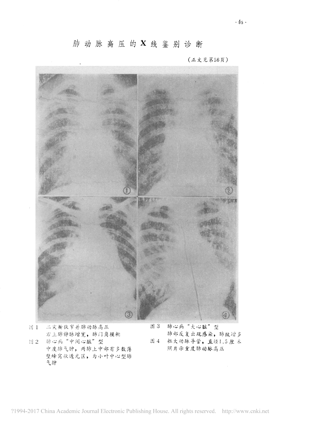呼吸疾病8-102慢性肺淤血，褐色硬化